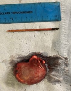 skewer-in-kidney-injury