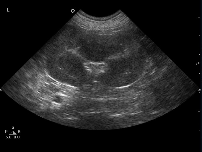 kidney ultrasound